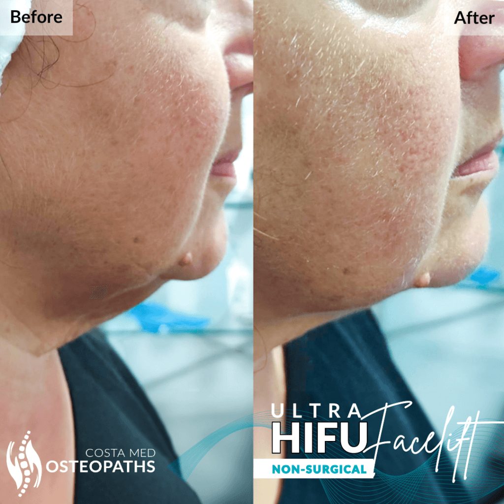 Before and after side profile of a woman’s chin and jawline showing visible lift after HIFU