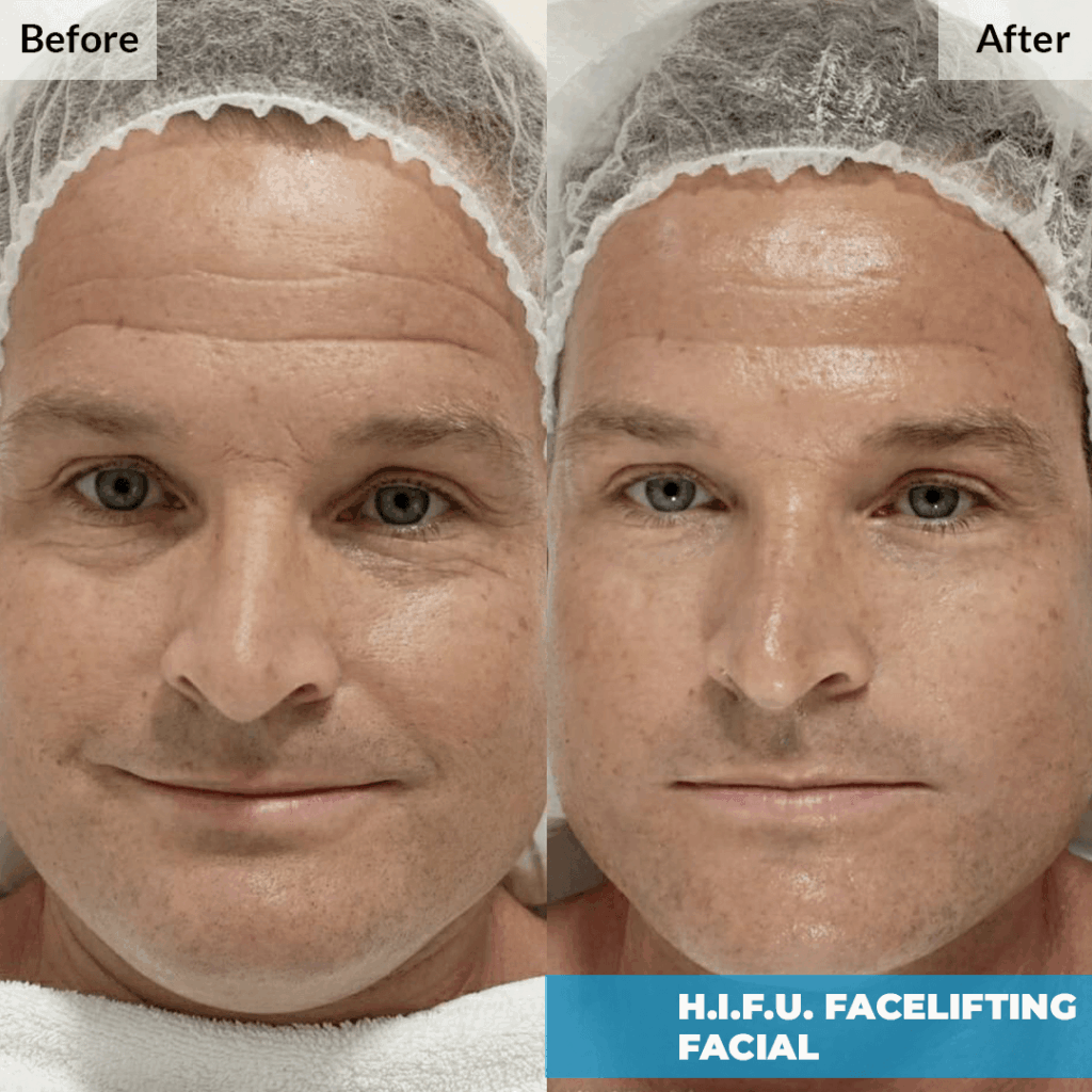 Side-by-side before/after image of man’s face showing visible skin tightening after HIFU facelift