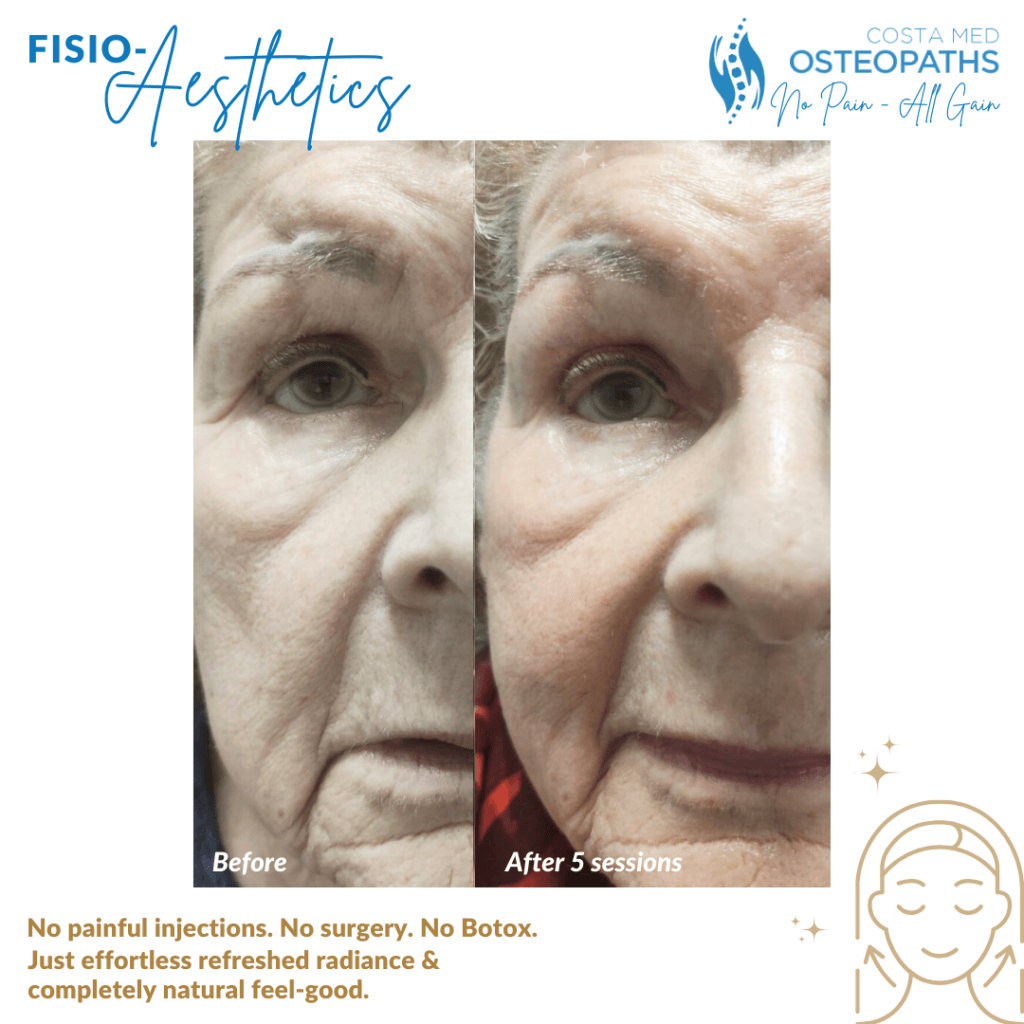 Before-and-after close-up image of woman’s face after five sessions of radiofrequency facials
