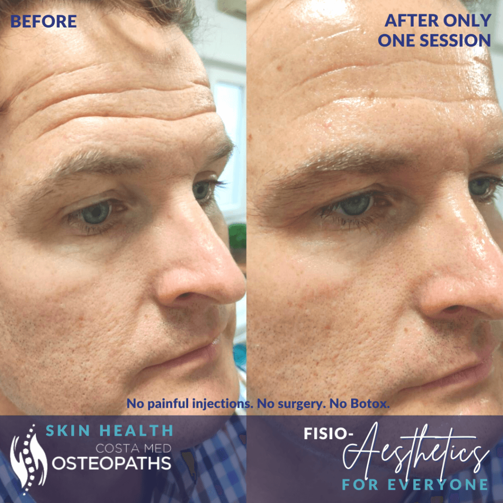 Before-and-after image of man’s face showing smoother skin and a healthy glow after one session