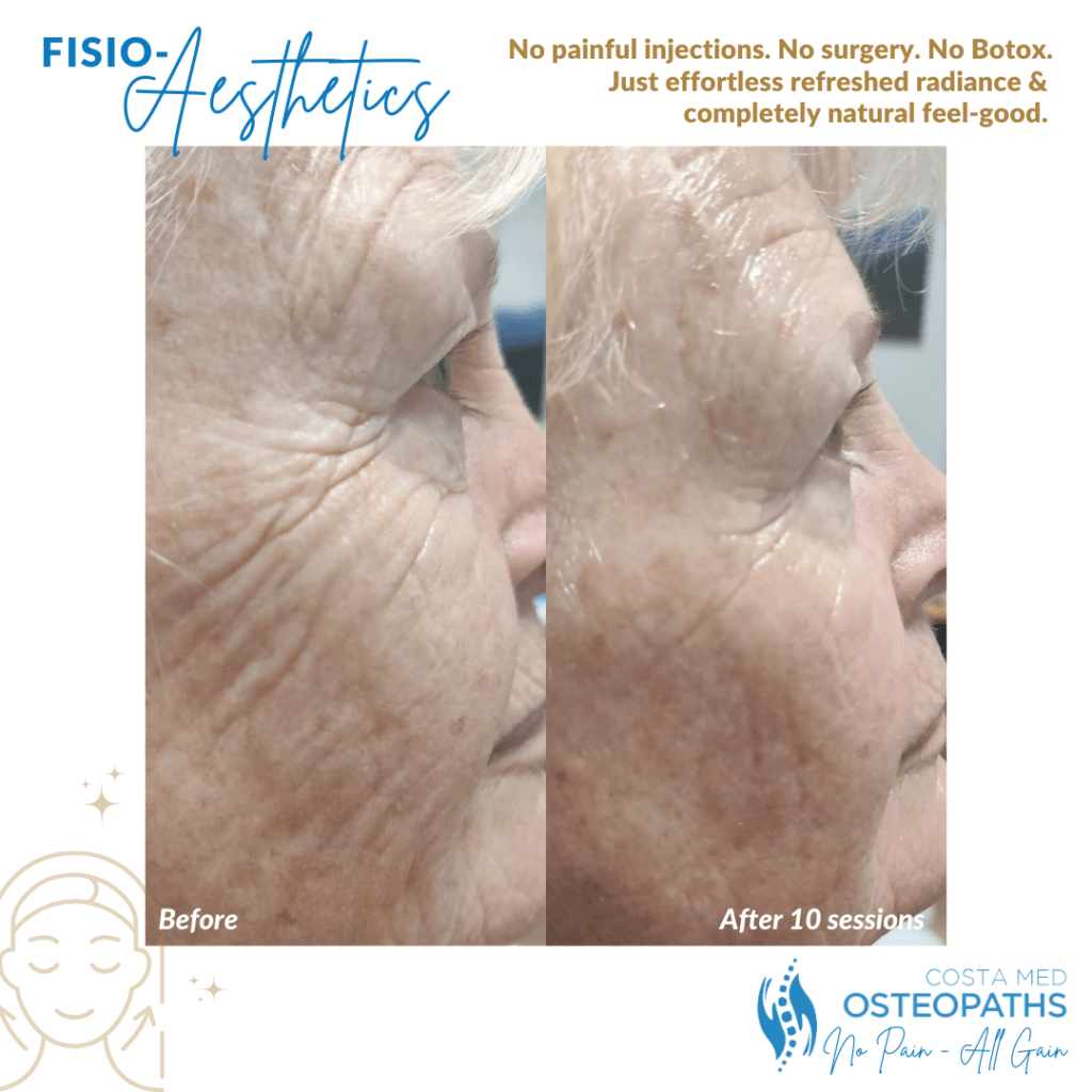 Profile before-and-after photo of older woman’s face after 10 sessions of radiofrequency facials