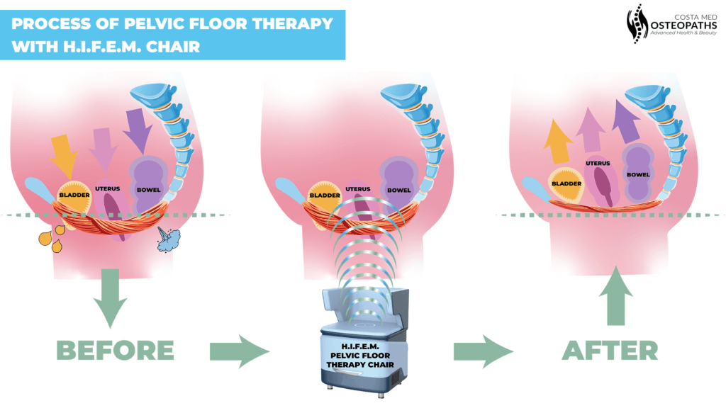 Illustration showing the process of pelvic floor therapy with the HIFEM pelvic floor chair