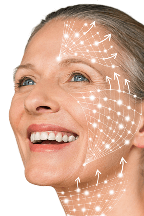 Smiling mature woman with graphic arrows showing facial lift effect from non-surgical HIFU