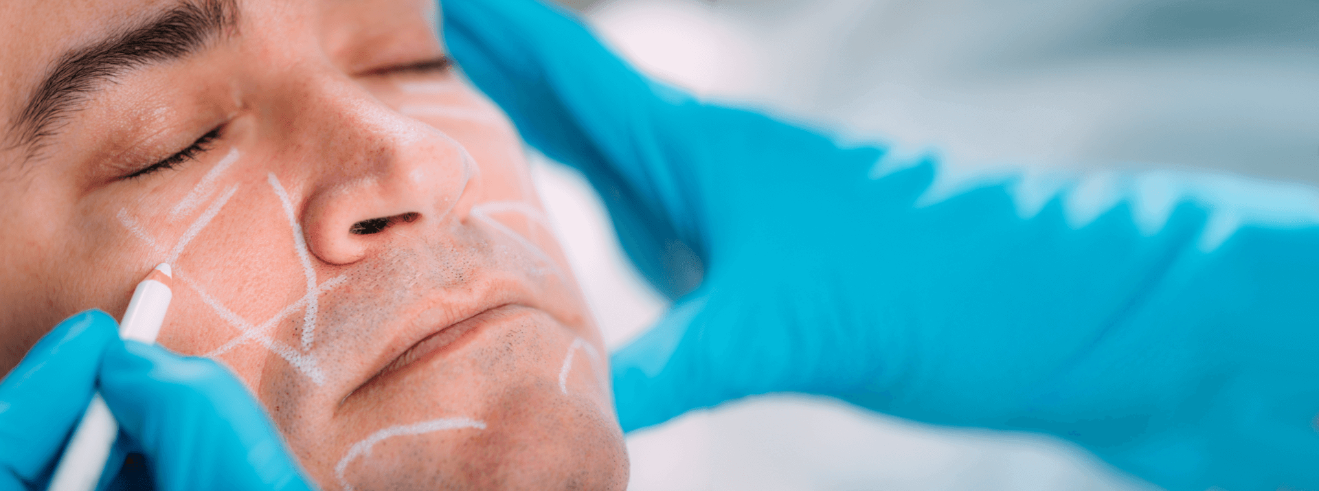 Close-up of HIFU treatment planning on a man's face with facial lift guidelines
